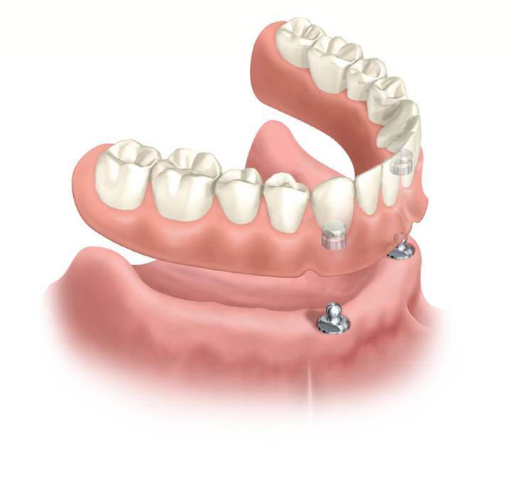 dental implants queens