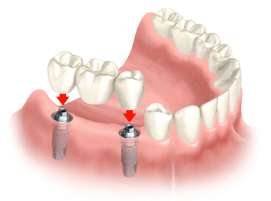 dental implants queens