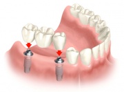 dental implants astoria