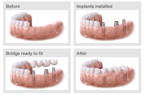  dental implants queens
