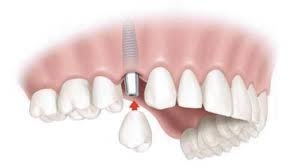 dental implants queens