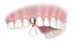 dental implants astoria